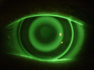 Safer Alternative to Laser Eye Surgery