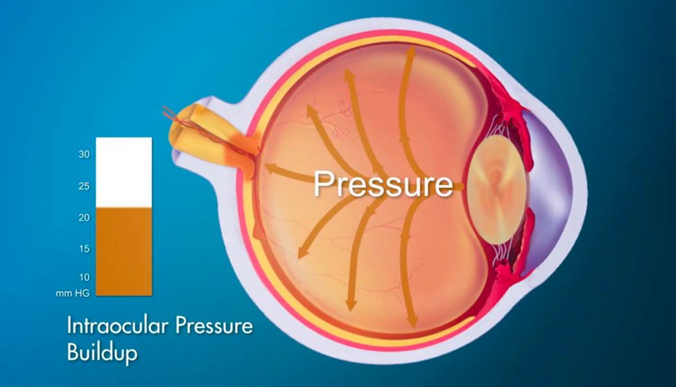 Graphic of an eyeball that has IOP, intraocular pressure buildup.